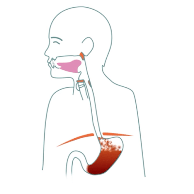 Acids leaking into the esophagus
